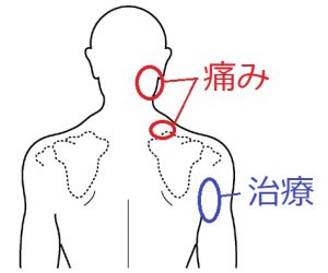 症状固定