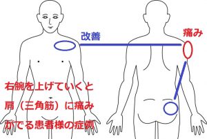 五十肩、四十肩の症例